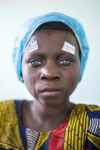 Cataracta
Dr. Hardi Richárd szemorvos húsz éve gyógyít Afrika szívében, a Kongói Demokratikus Köztársaságban. Richárd a két magyarországnyi területű megye központjában, Mbuji-Mayiban dolgozik, a térség egyetlen jól felszerelt műtőjében. Innen indul csillagtúraszerűen a megye eldugott szegleteibe, hogy esélyt adjon azoknak a betegeknek is, akik 600–800 kilométerre laknak a szemészeti centrumtól. Az egyenlítői nap ereje és a szűrés hiánya miatt ez a régió különösen érintett a hályogos megbetegedésekben, pedig ez a szembetegség 15 perces egyszerű rutinműtéttel kezelhető volna. 
